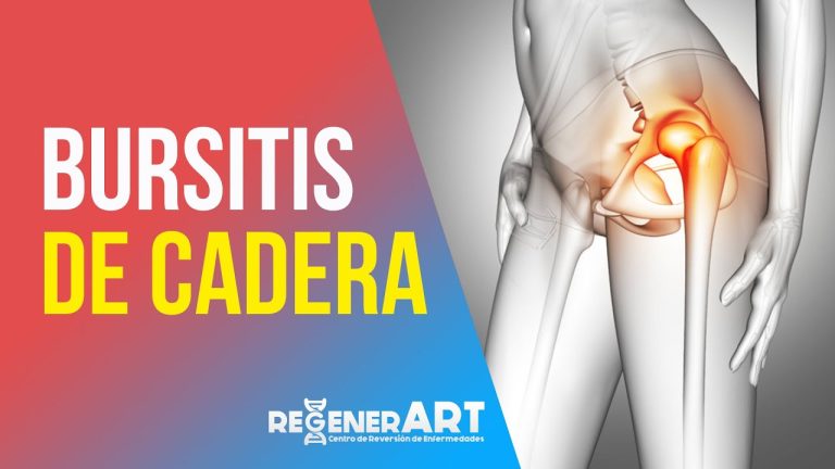 Bursitis De Cadera Sintomas Actualizado Junio 2024 4387